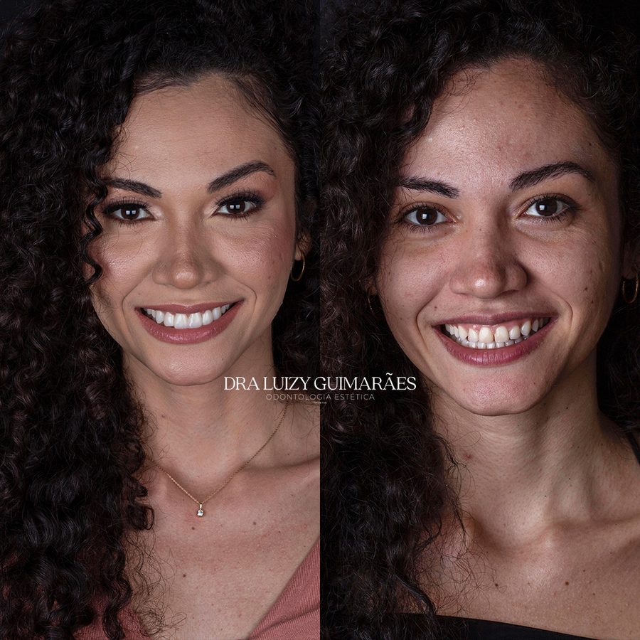Antes e depois facetas resina