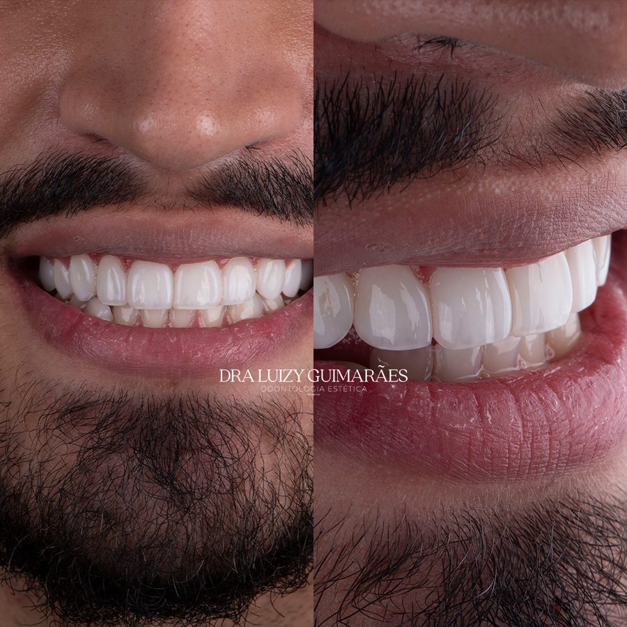 Antes e depois facetas resina
